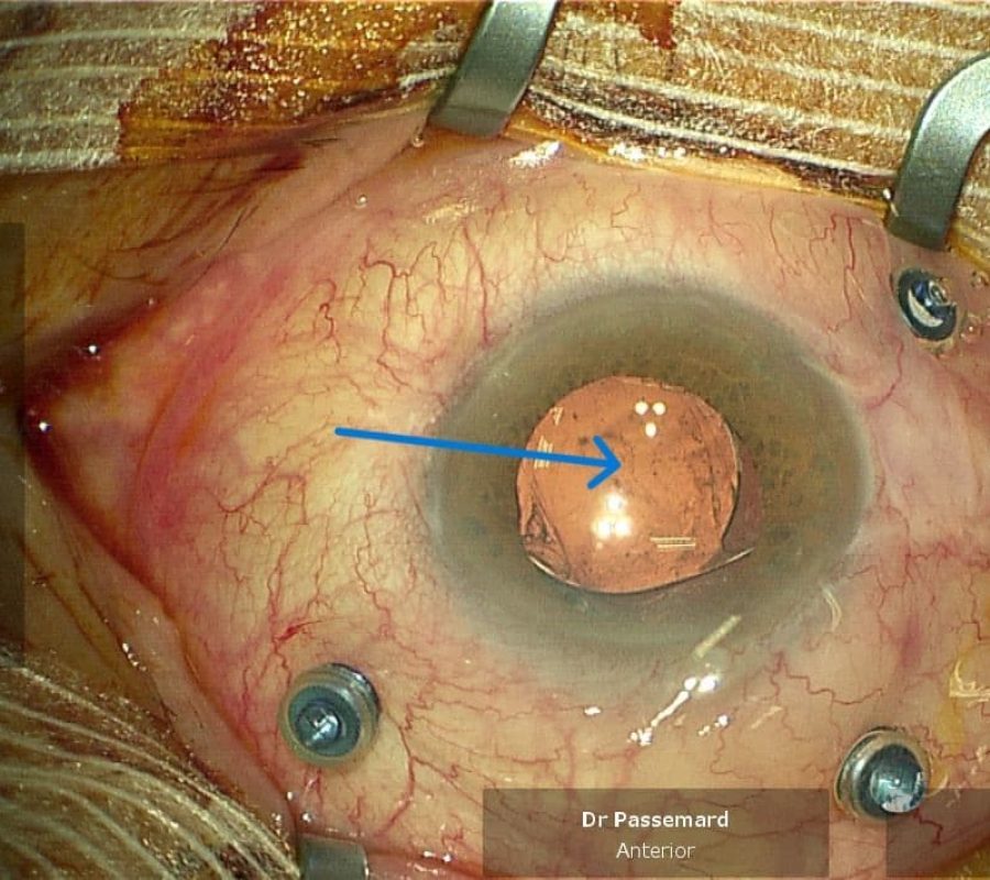 Corps flottants situés en arrière de l'implant