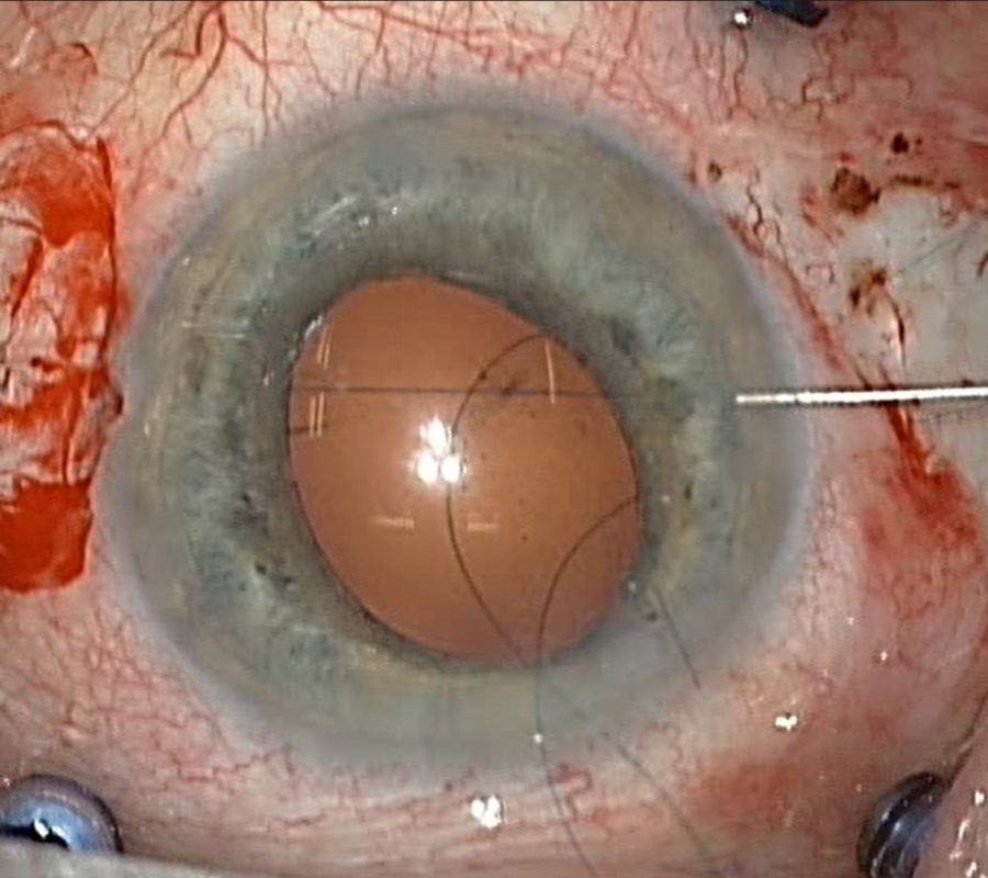 Implant suturé 3 pièces 2