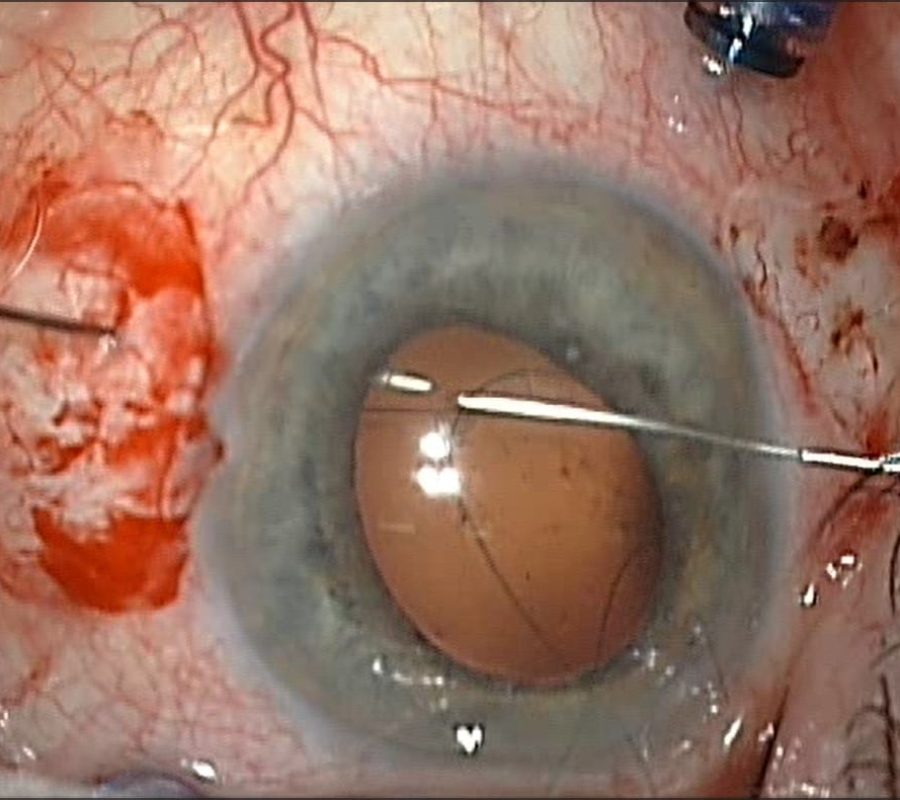 Suture implant à la sclère 1